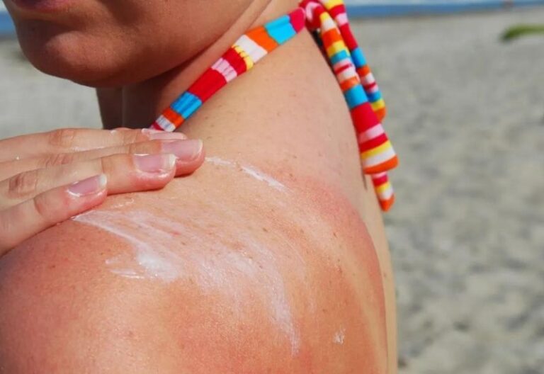 chăm sóc da bị cháy nắng