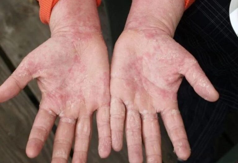 chăm sóc da nhiễm corticoid