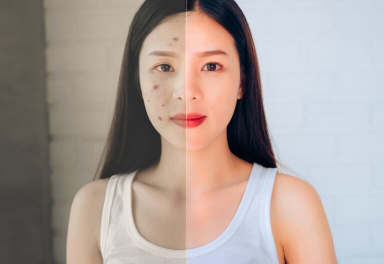 quy trình chăm sóc da mụn hàng ngày