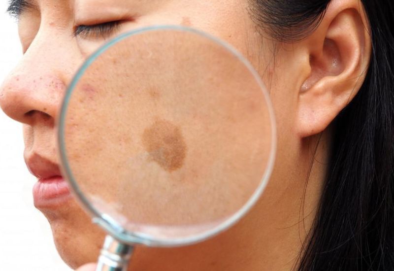 các loại nám da phổ biến