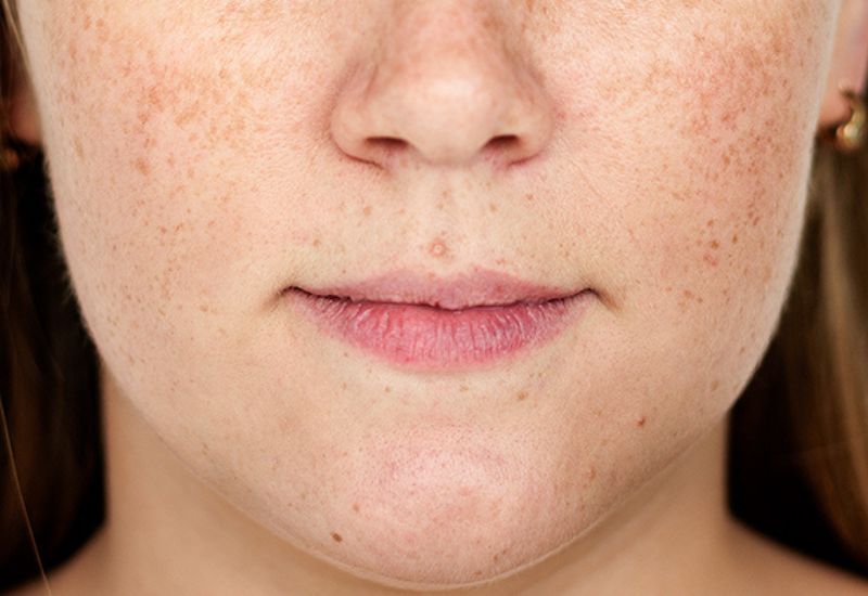 da bị nám do nội tiết